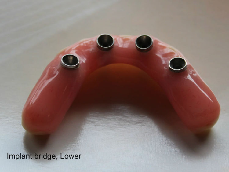 Implant Dentures Dental Solutions West Dentures, Implant Dentures