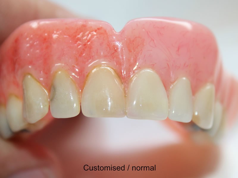 The image of customised dentures - variant 2