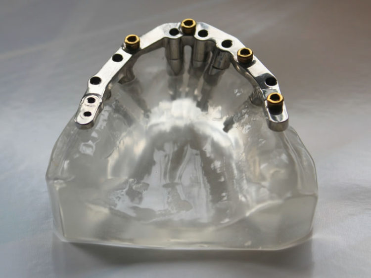 Implant Dentures Dental Solutions West Dentures, Implant Dentures