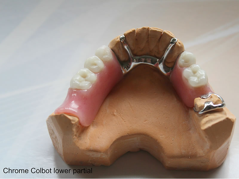 Image 1 of Chrome Cobalt lower partial dentures