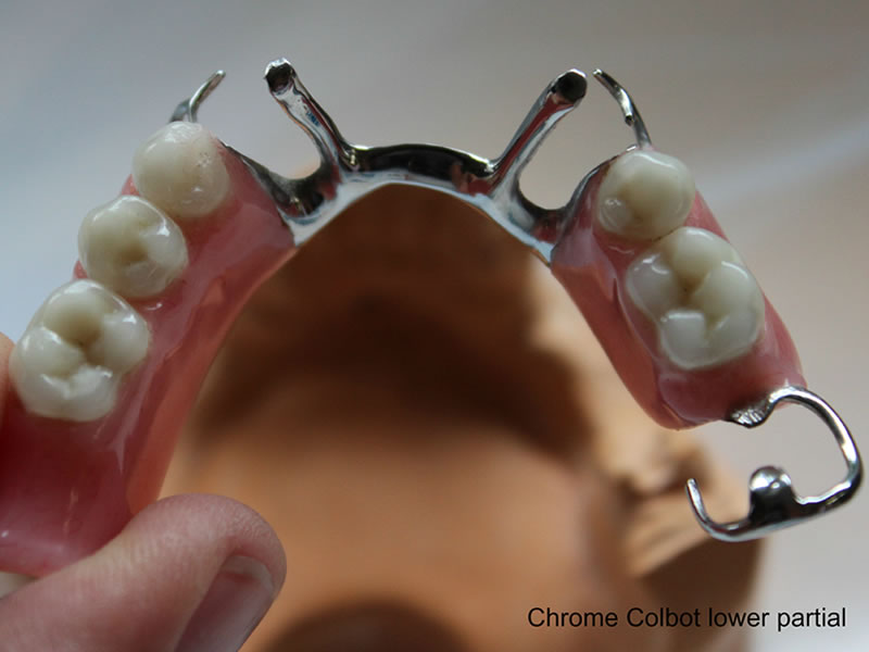 Image 2 of Chrome Cobalt lower partial dentures