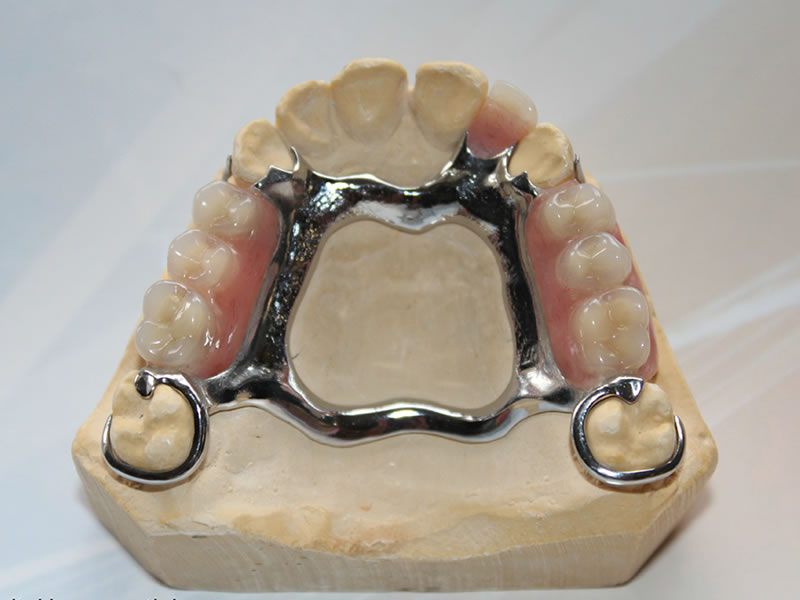 Image of Upper Cobalt partial dentures
