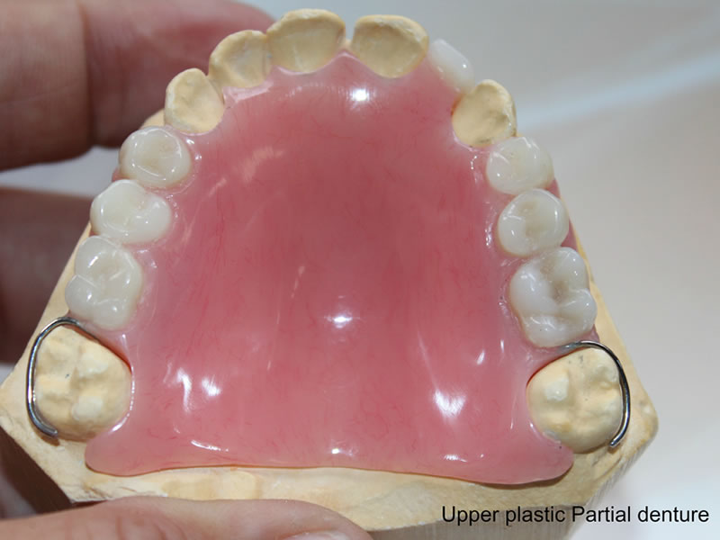 Image of Upper Plastic partial dentures