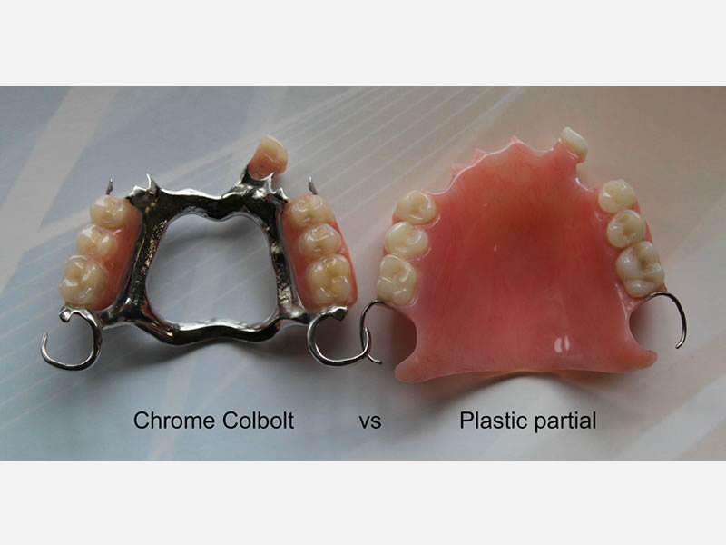 Image of Upper Cobalt vs Upper Plastic partial dentures
